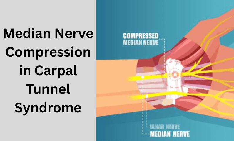 The Impact of Median Nerve Compression in Carpal Tunnel Syndrome